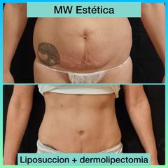 Dermolipectomía - Mw Estética