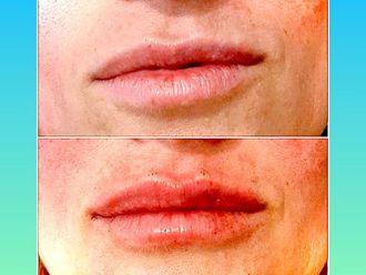 Relleno de labios-797758