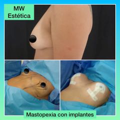 Mastopexia - Mw Estética