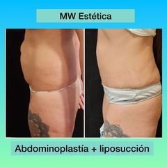 Abdominoplastia - Mw Estética