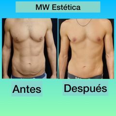 Liposucción - Mw Estética