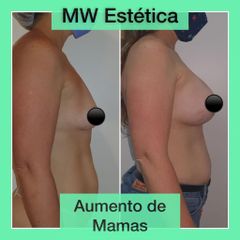 Aumento mamas - Mw Estética