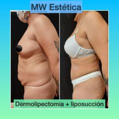 Dermolipectomía - Mw Estética