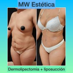 Dermolipectomía - Mw Estética
