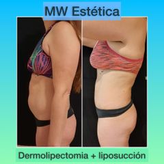 Dermolipectomía - Mw Estética