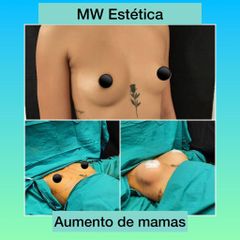 Aumento mamas - Mw Estética