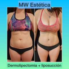 Dermolipectomía - Mw Estética