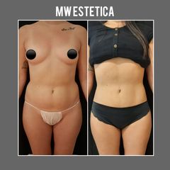 Liposucción - Mw Estética