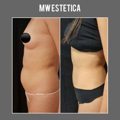 Liposucción - Mw Estética