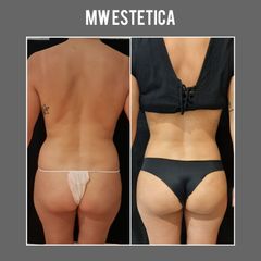 Liposucción - Mw Estética
