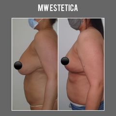 Reducción de mamas - Mw Estética