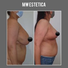 Reducción de mamas - Mw Estética