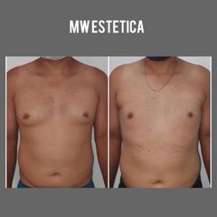 Ginecomastia - Mw Estética