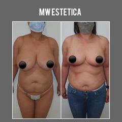 Reducción de mamas - Mw Estética