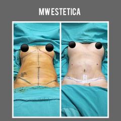 Abdominoplastia - Mw Estética