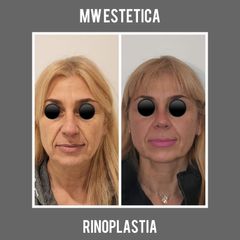 Rinoplastia - Mw Estética