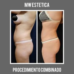 Liposucción - Mw Estética