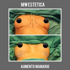 Aumento mamas - Mw Estética