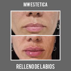 Relleno de labios - Mw Estética