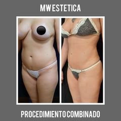 Liposucción - Mw Estética