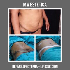 Dermolipectomía - Mw Estética