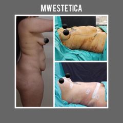 Lipoescultura - Mw Estética