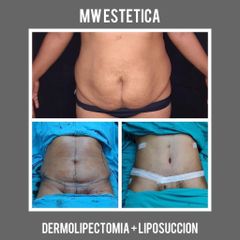 Dermolipectomía - Mw Estética