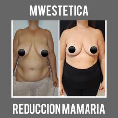 Reducción mamas - Mw Estética