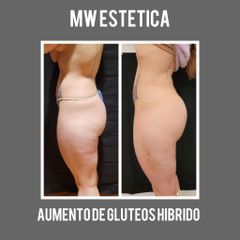 Aumento de glúteos - Mw Estética