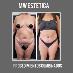 Abdominoplastia - Mw Estética