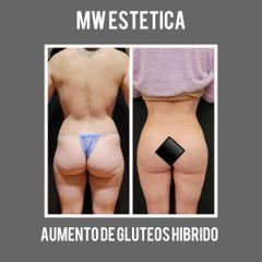 Aumento de glúteos - Mw Estética