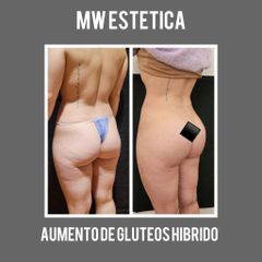 Aumento de glúteos - Mw Estética