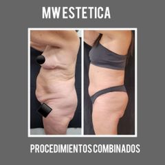 Abdominoplastia - Mw Estética