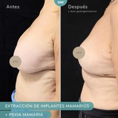 Mastopexia - Mw Estética