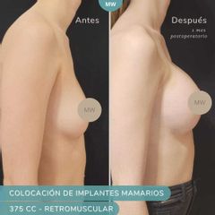 Aumento mamas - Mw Estética