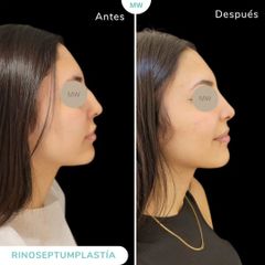 Rinoplastia - Mw Estética