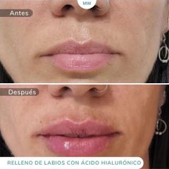 Relleno de labios - Mw Estética