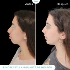 Rinoplastia - Mw Estética