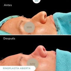 Rinoplastia - Mw Estética