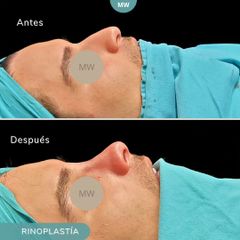 Rinoplastia - Mw Estética