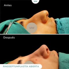 Rinoplastia - Mw Estética