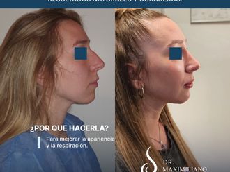 Rinoplastia antes y después - 877450