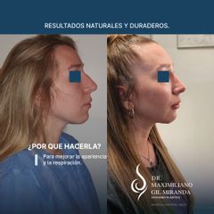 Rinoplastia - Dr. Maximiliano Gil Miranda