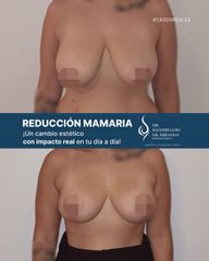 Reducción Mamaria - Dr. Maximiliano Gil Miranda