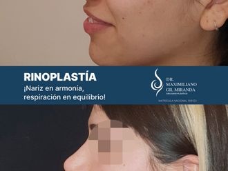 Rinoplastia antes y después - 877452