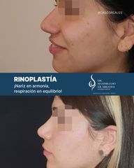 Rinoplastia - Dr. Maximiliano Gil Miranda