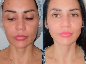 Hilos tensores antes y después - 877453