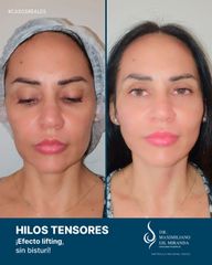 Hilos Tensores - Dr. Maximiliano Gil Miranda