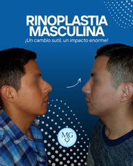 Rinoplastia Masculina - Dr. Maximiliano Gil Miranda