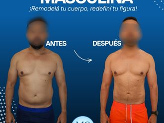 Liposucción antes y después - 877460